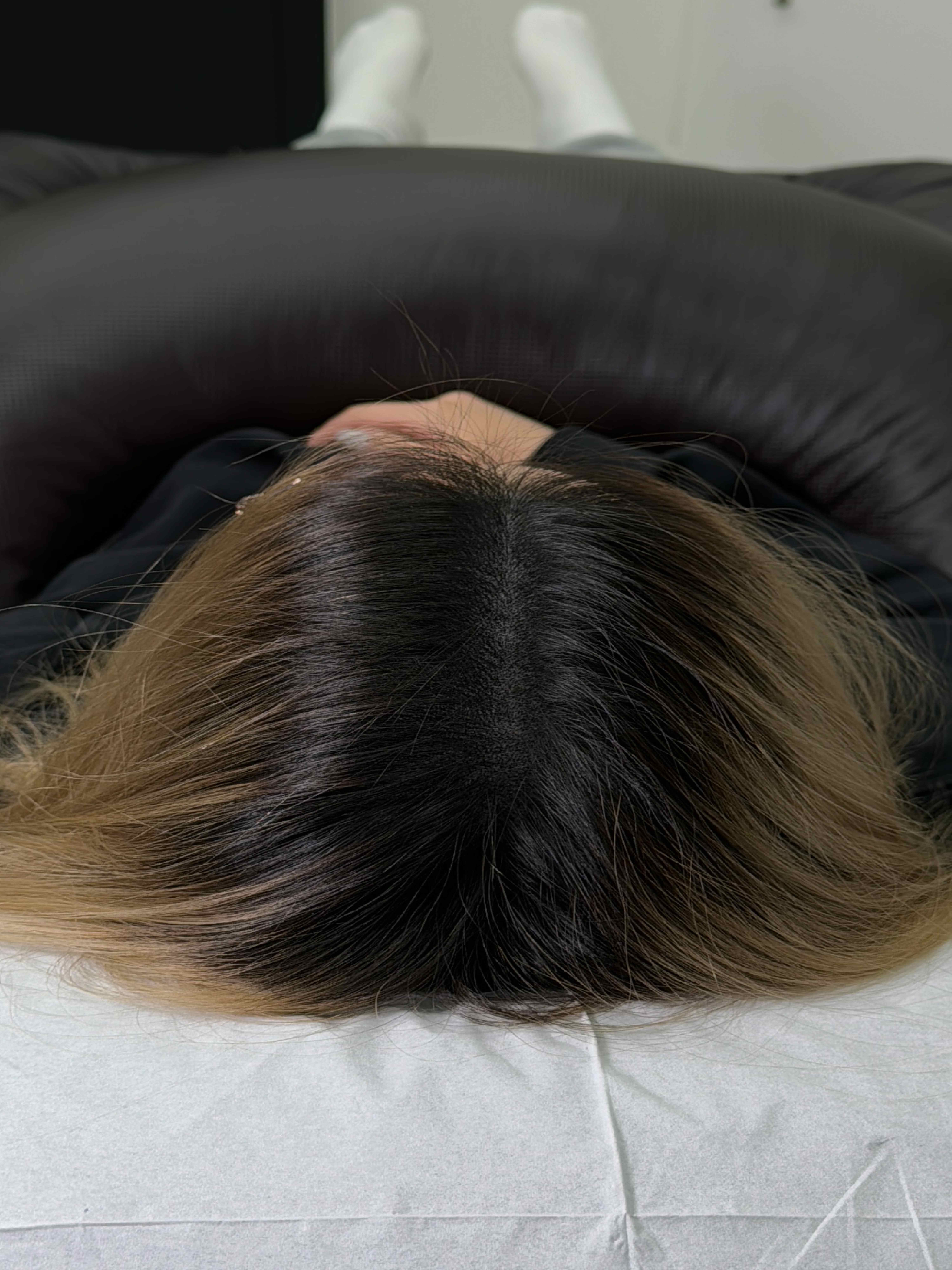 가르마 시술 - 시술 후