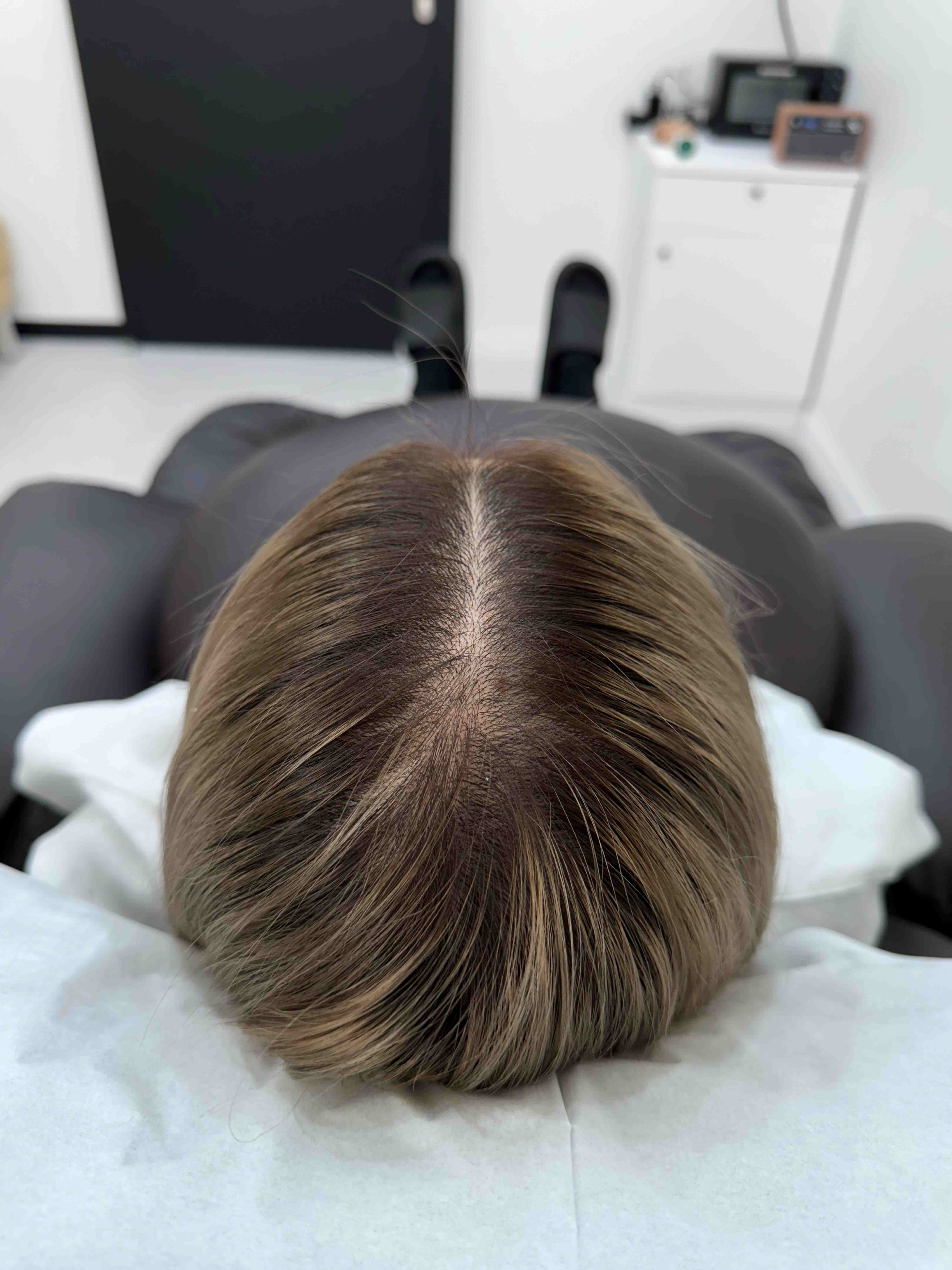 가르마 시술 - 시술 전