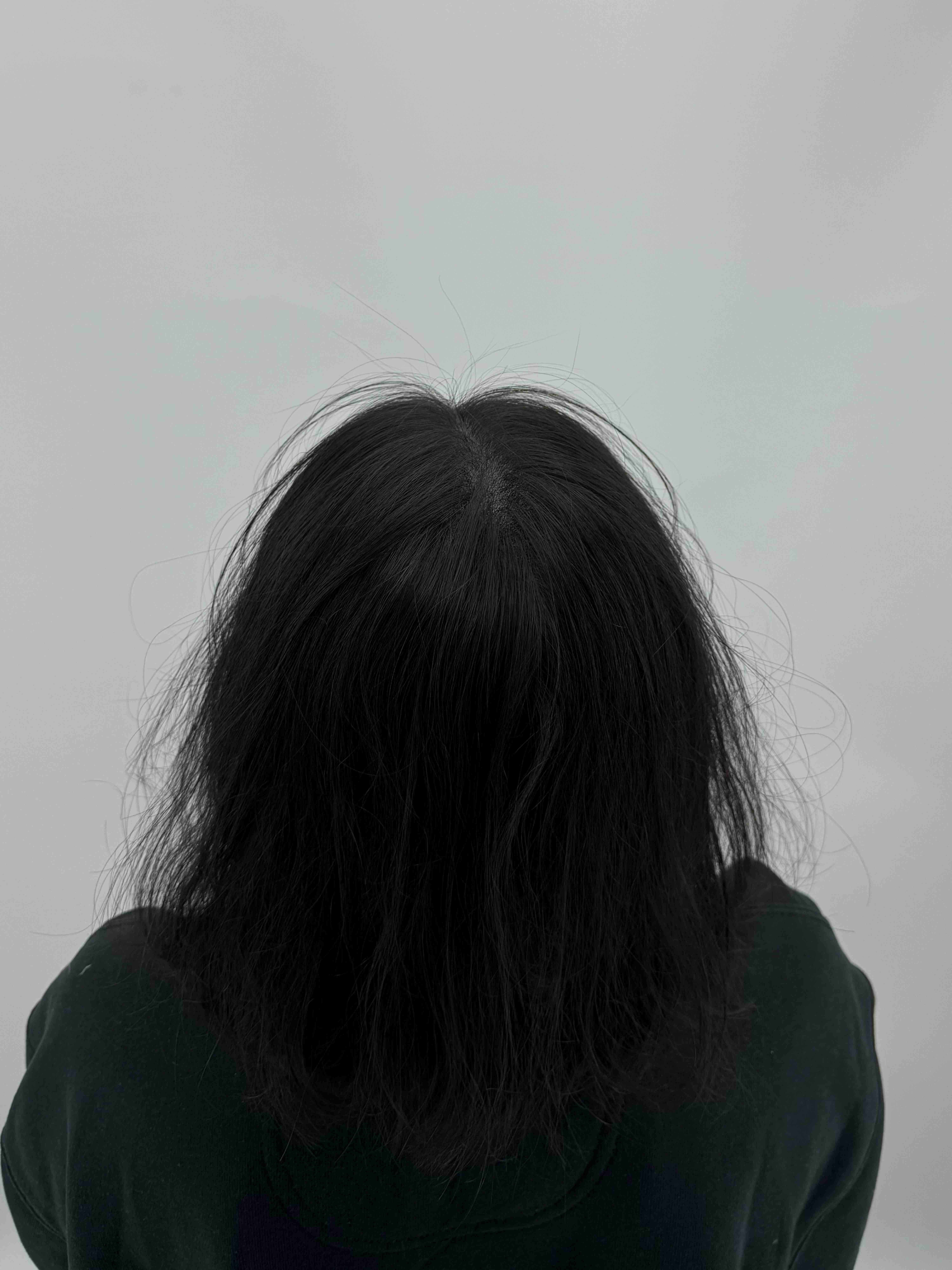 가르마 시술 - 시술 후