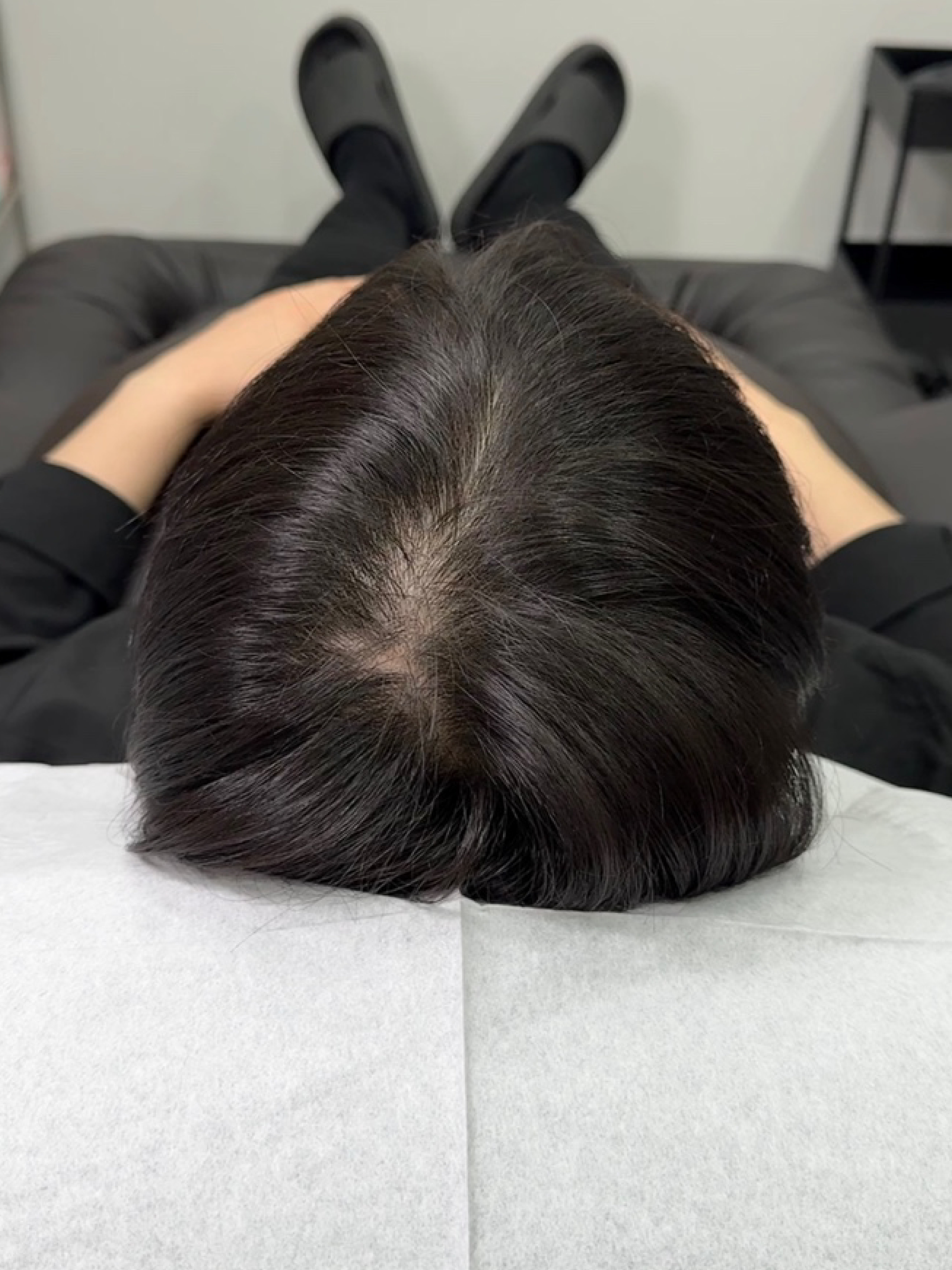 가르마 시술 - 시술 전