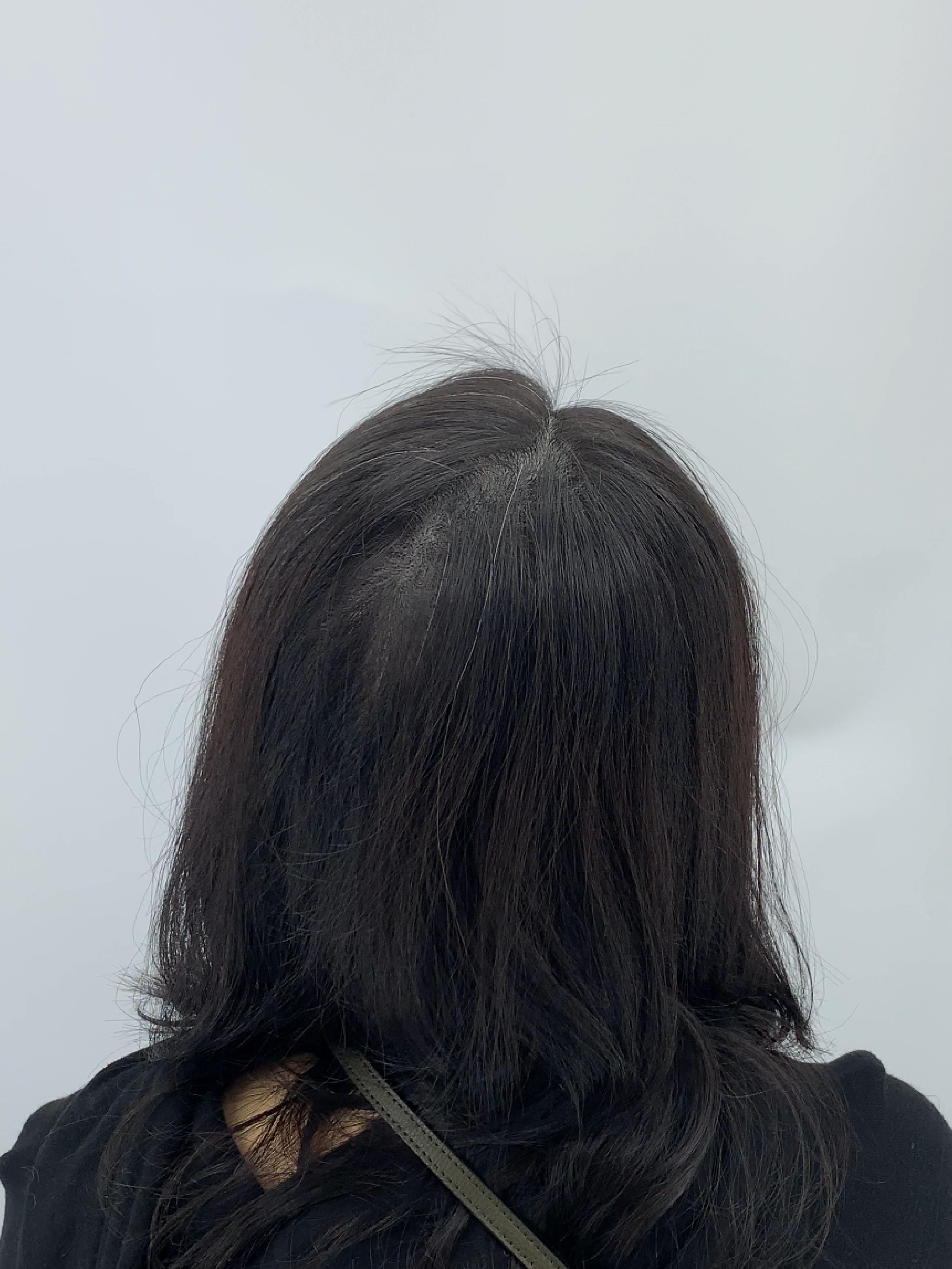 가르마 시술 - 시술 후