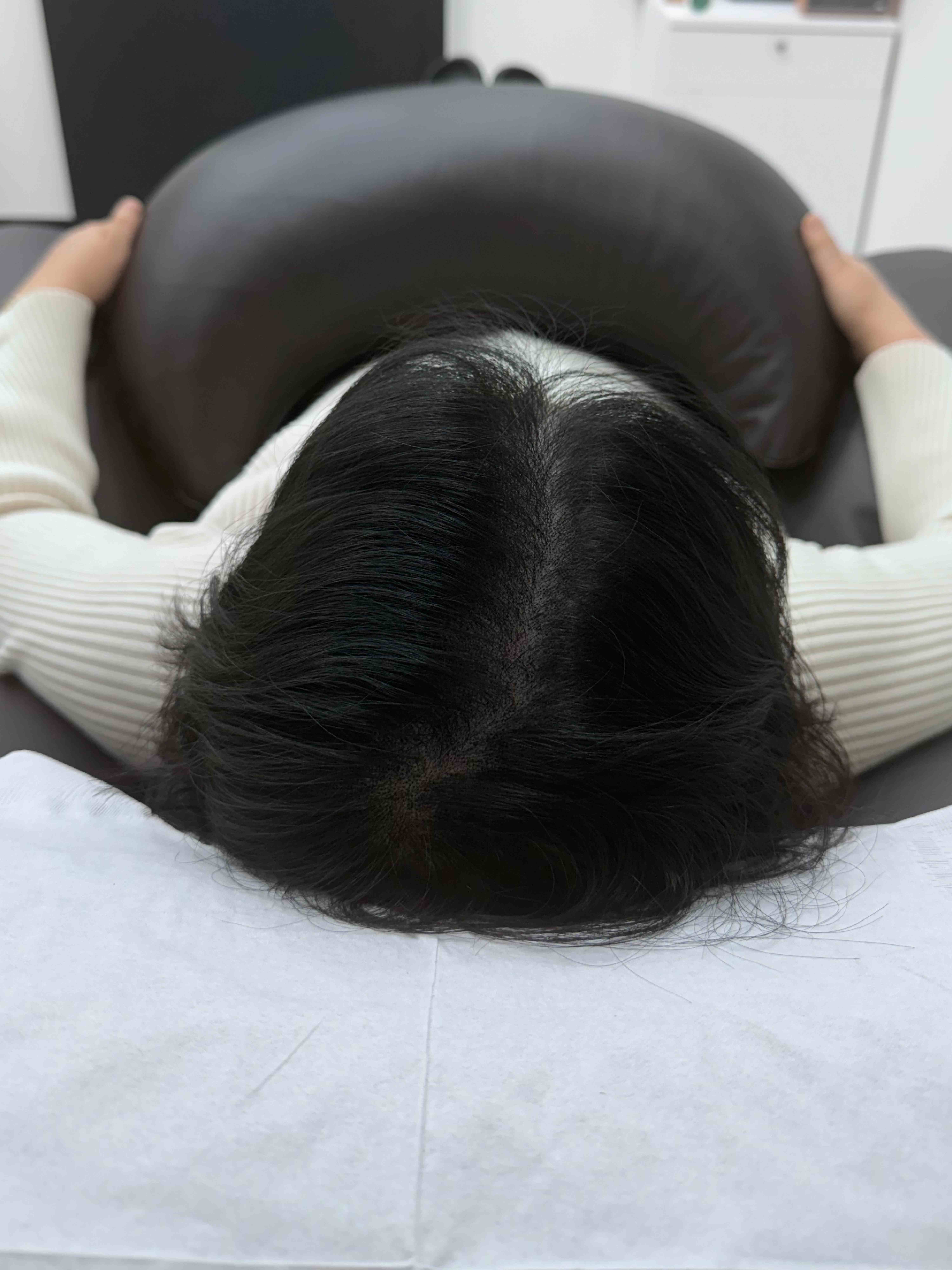 가르마 시술 - 시술 후