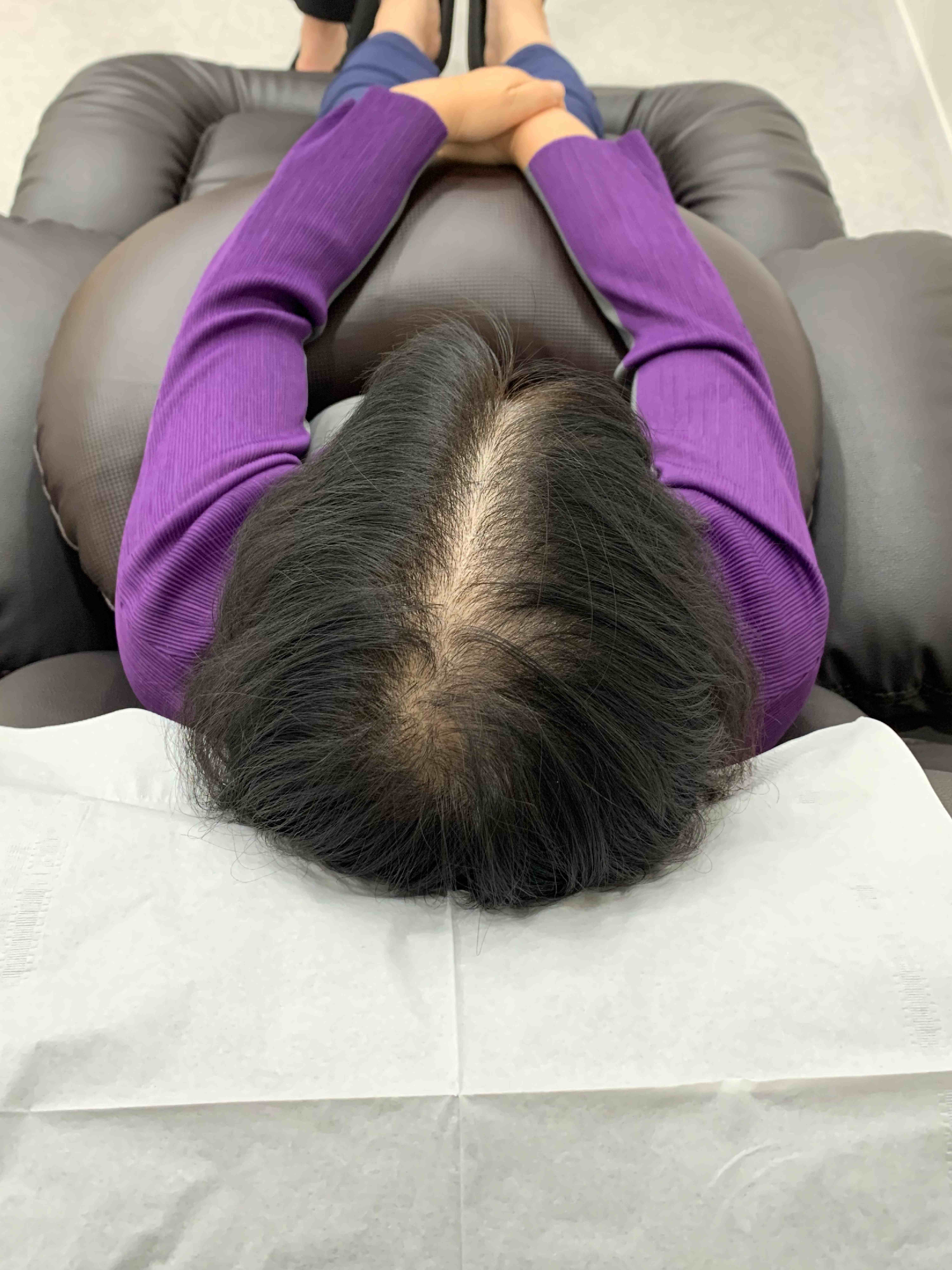 가르마 시술 - 시술 전