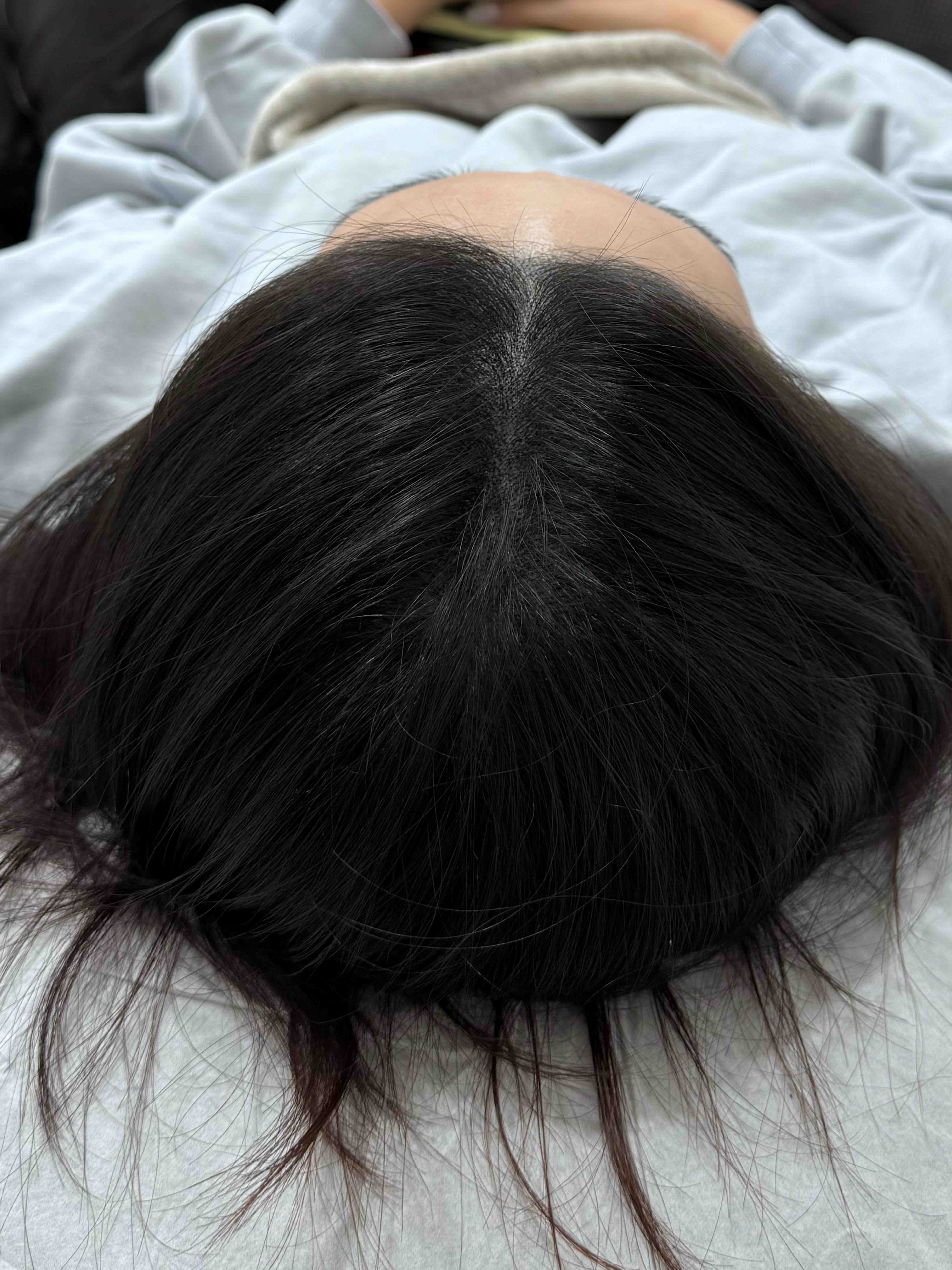 가르마 시술 후