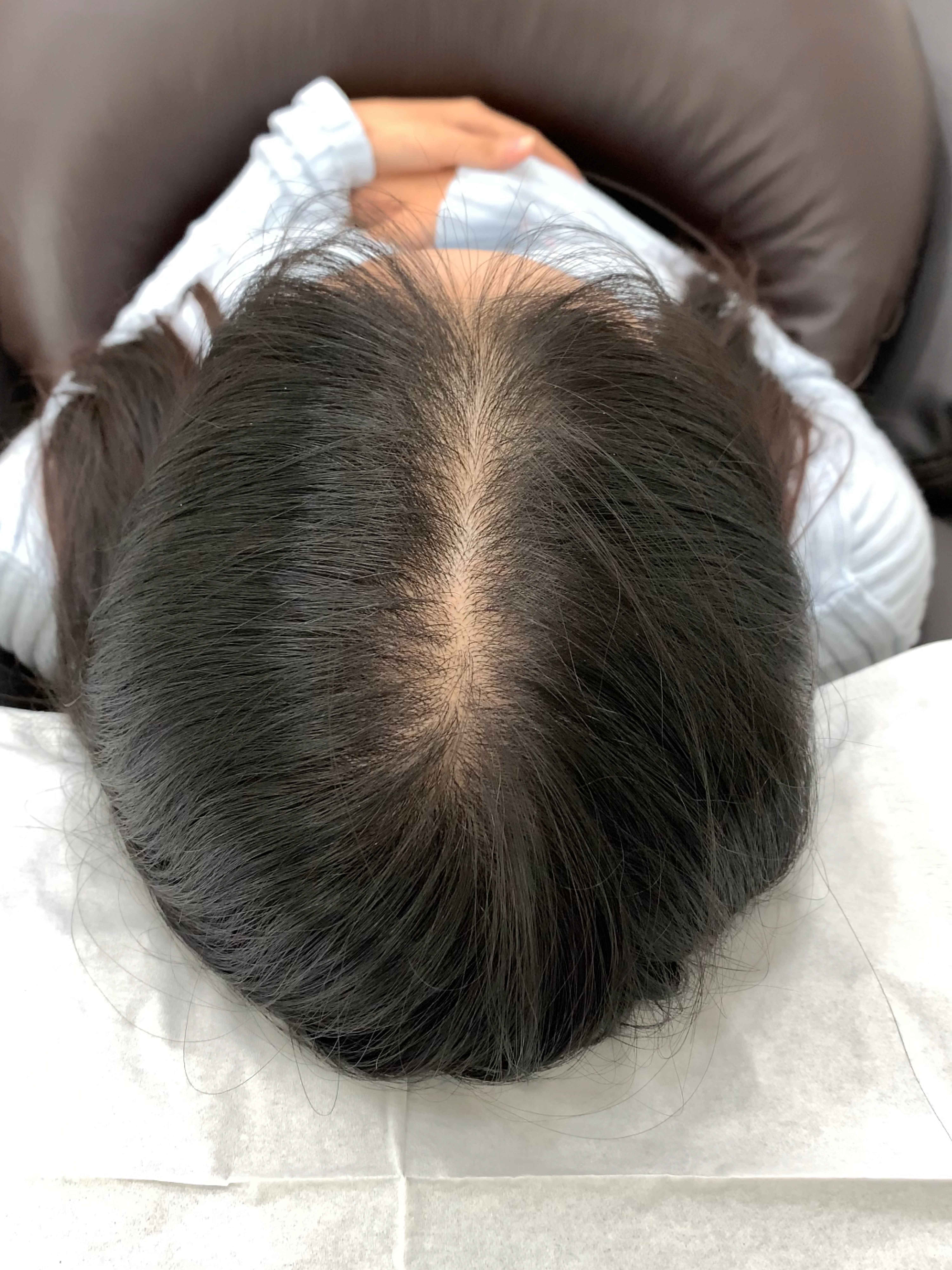 가르마 시술 전
