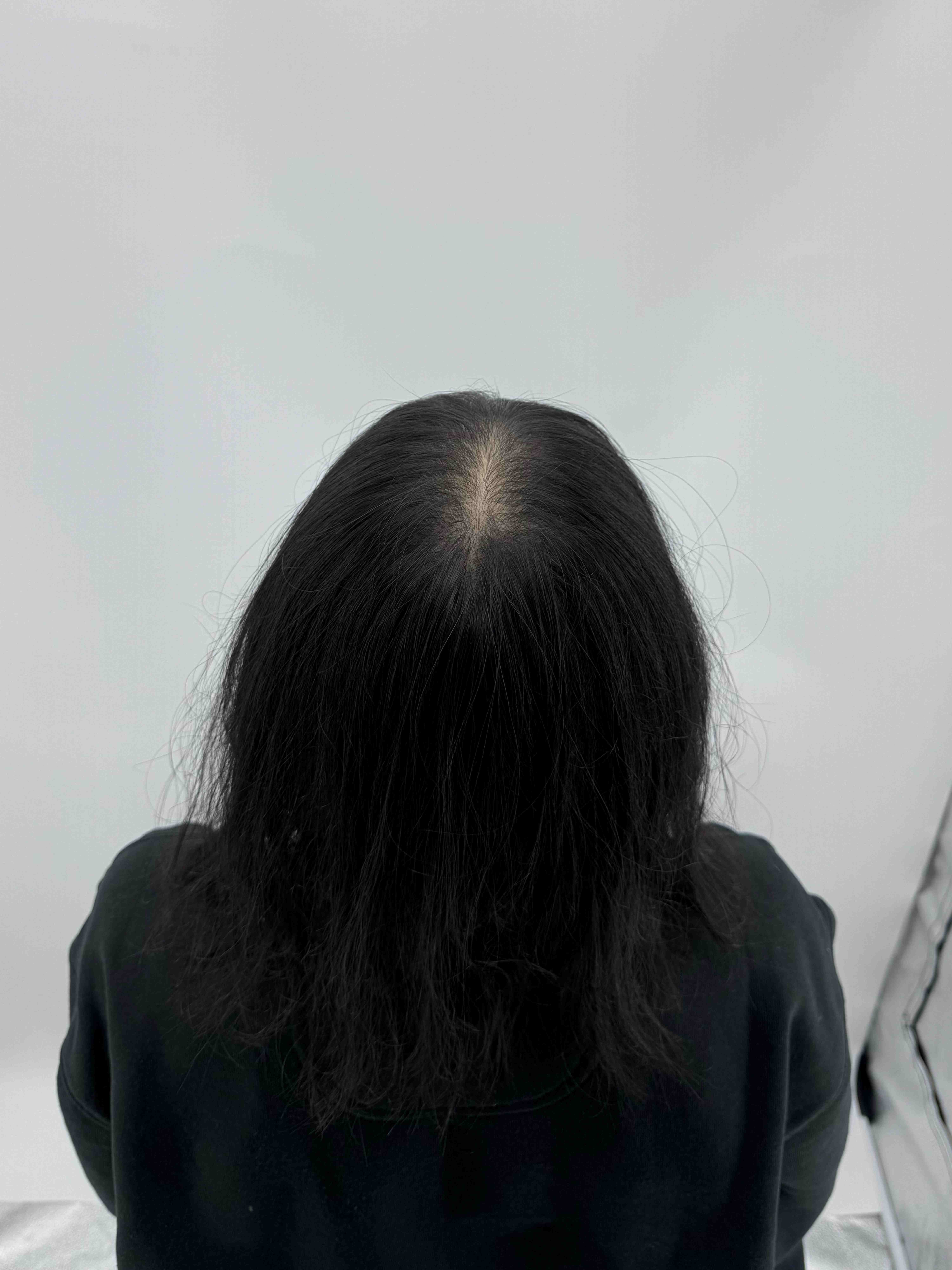 가르마 시술 - 시술 전