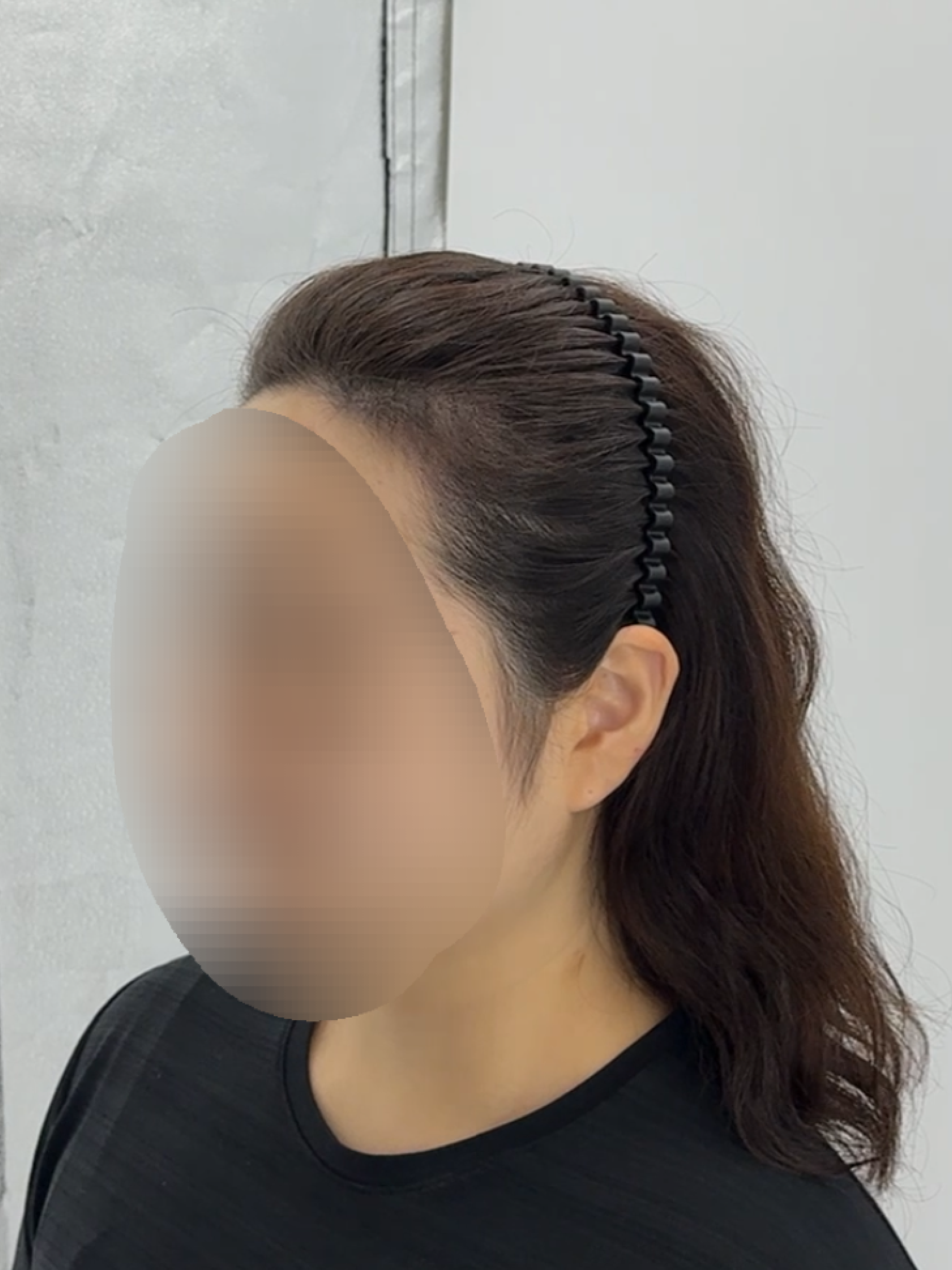 여성 헤어라인 시술 - 시술 후