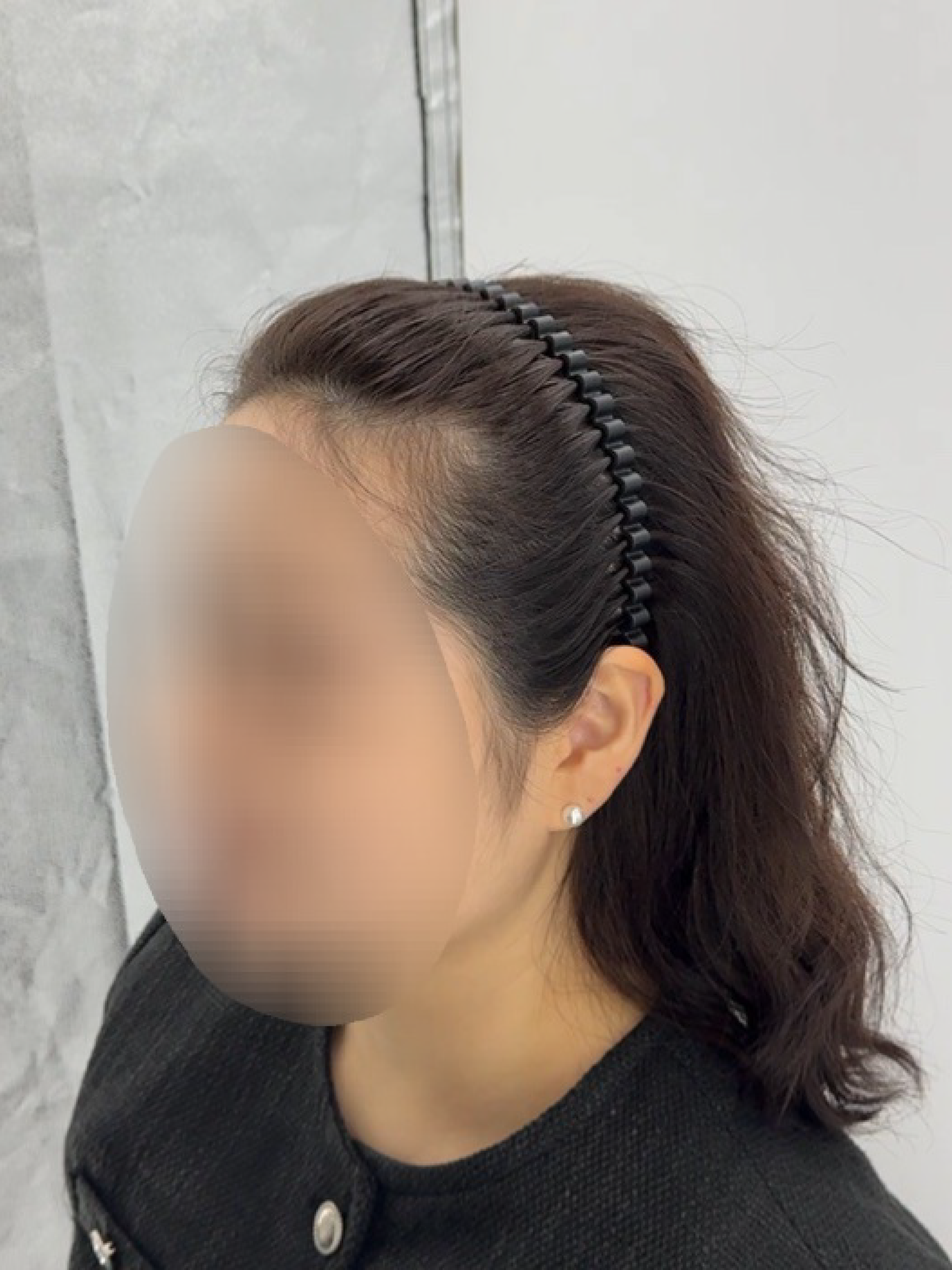 여성 헤어라인 시술 - 시술 전