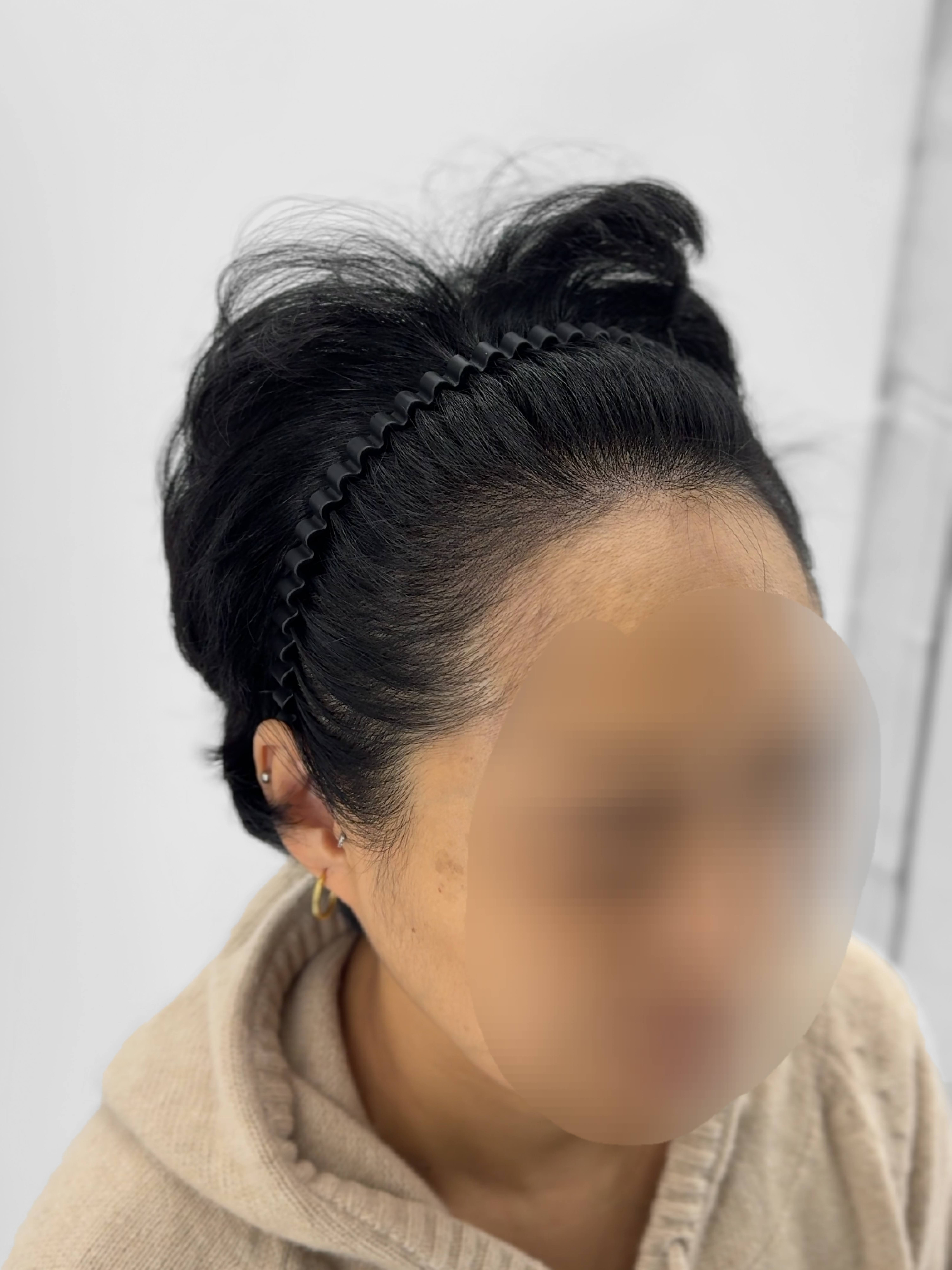 여성 헤어라인 시술 - 시술 후