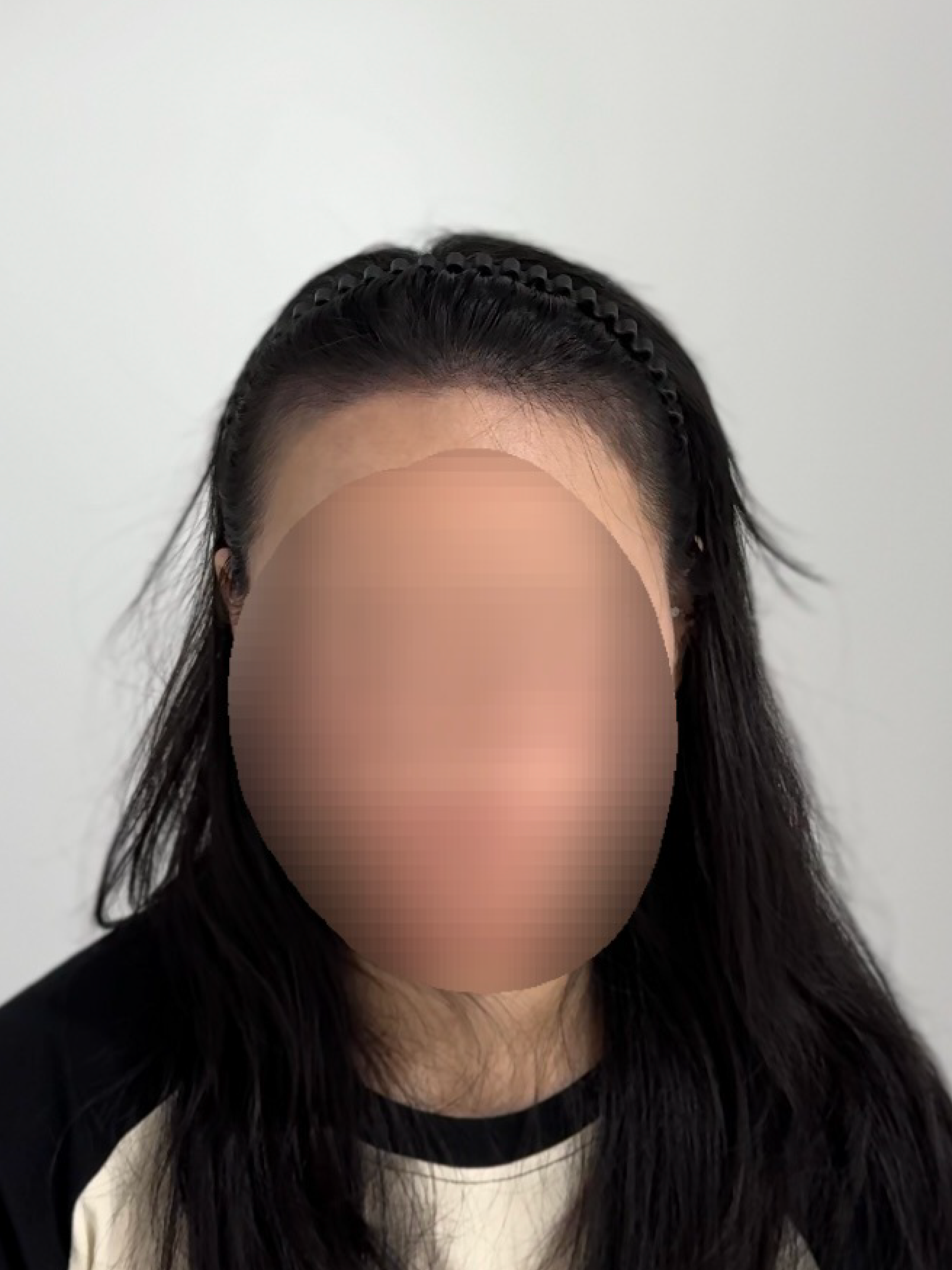 여성 헤어라인 시술 - 시술 후