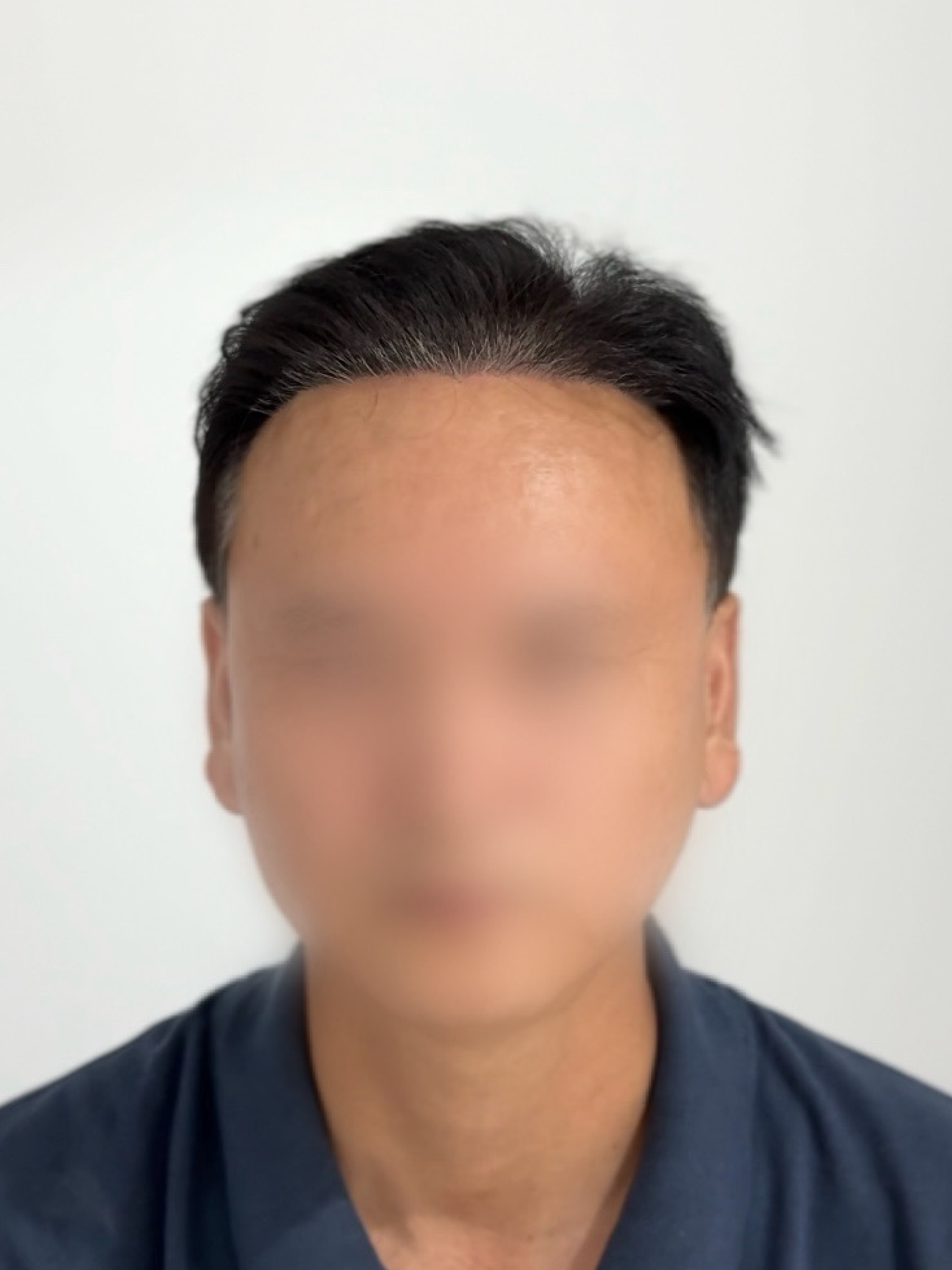 남성 헤어라인 시술 - 시술 후