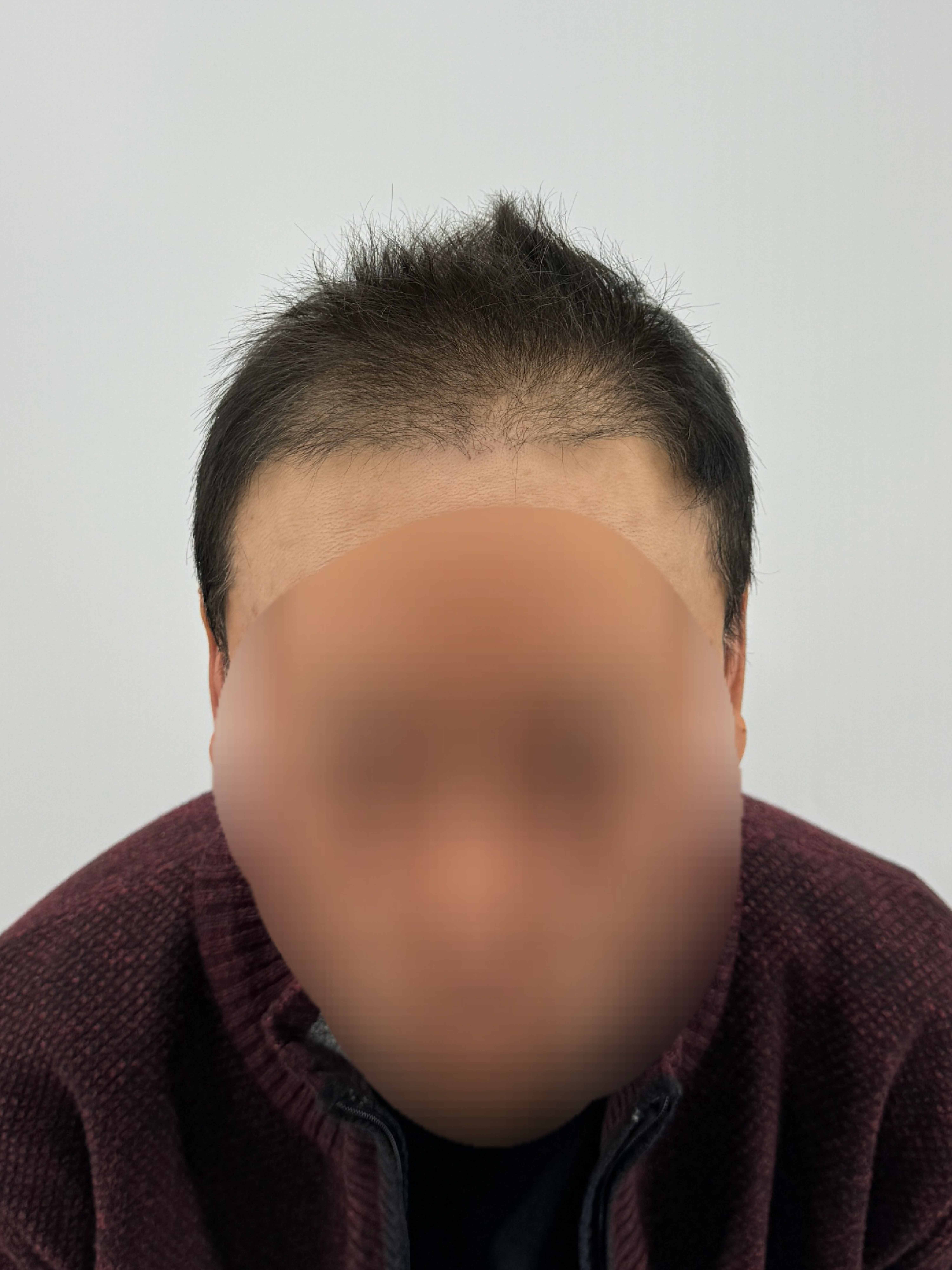 남성 헤어라인 시술 - 시술 전