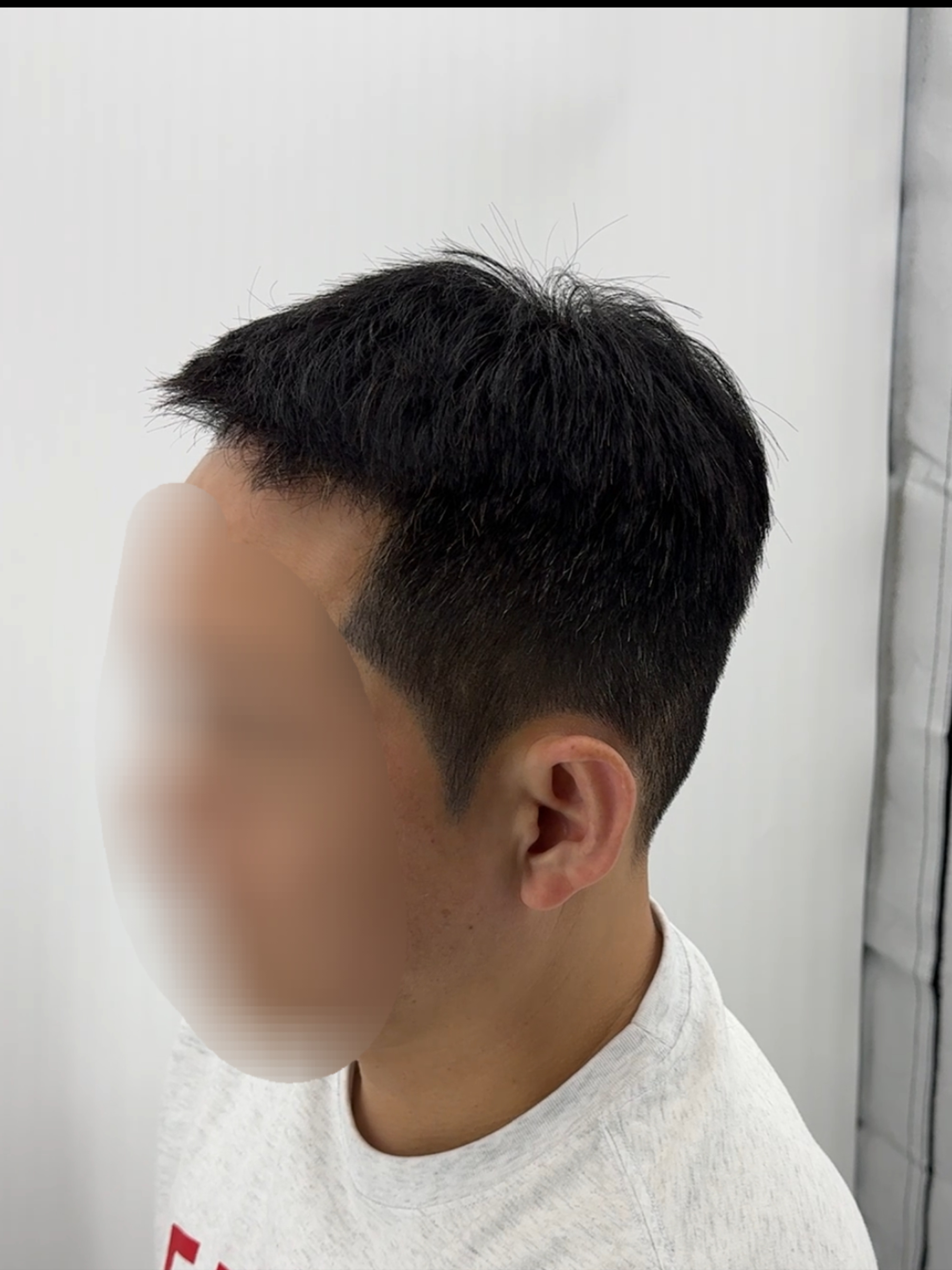 남성 헤어라인 시술 - 시술 후