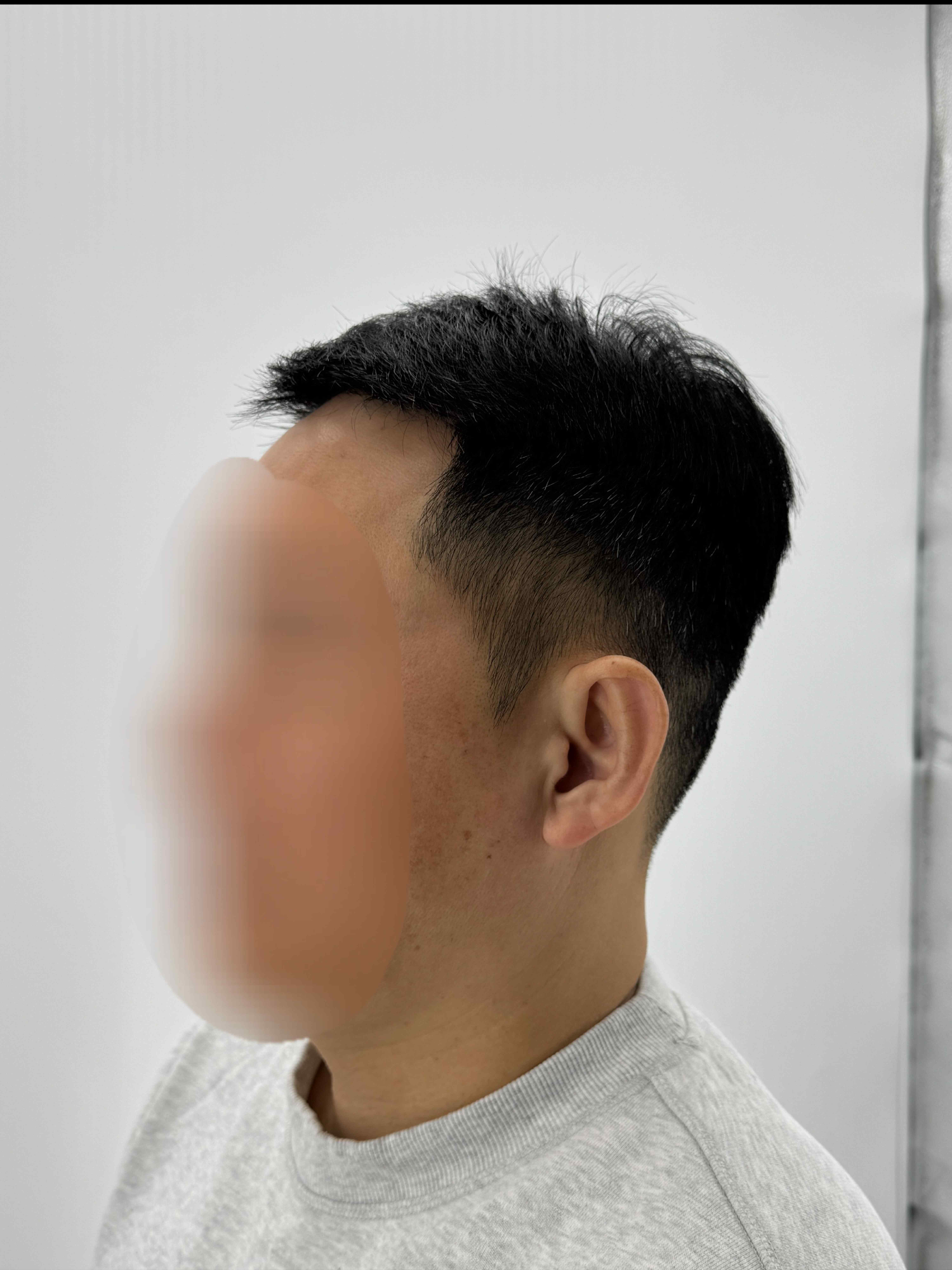 남성 헤어라인 시술 - 시술 전