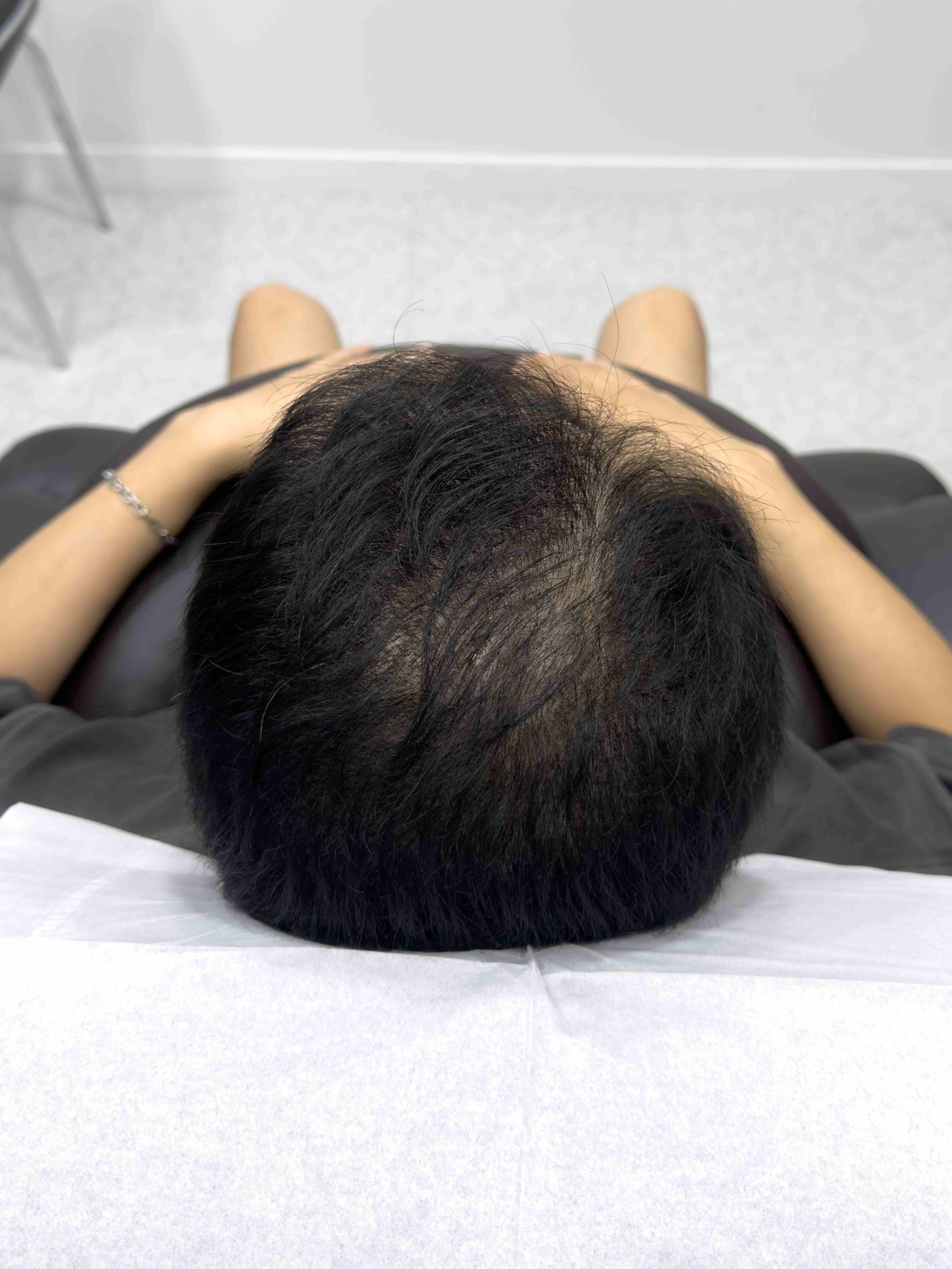 정수리 SMP 시술 - 시술 전