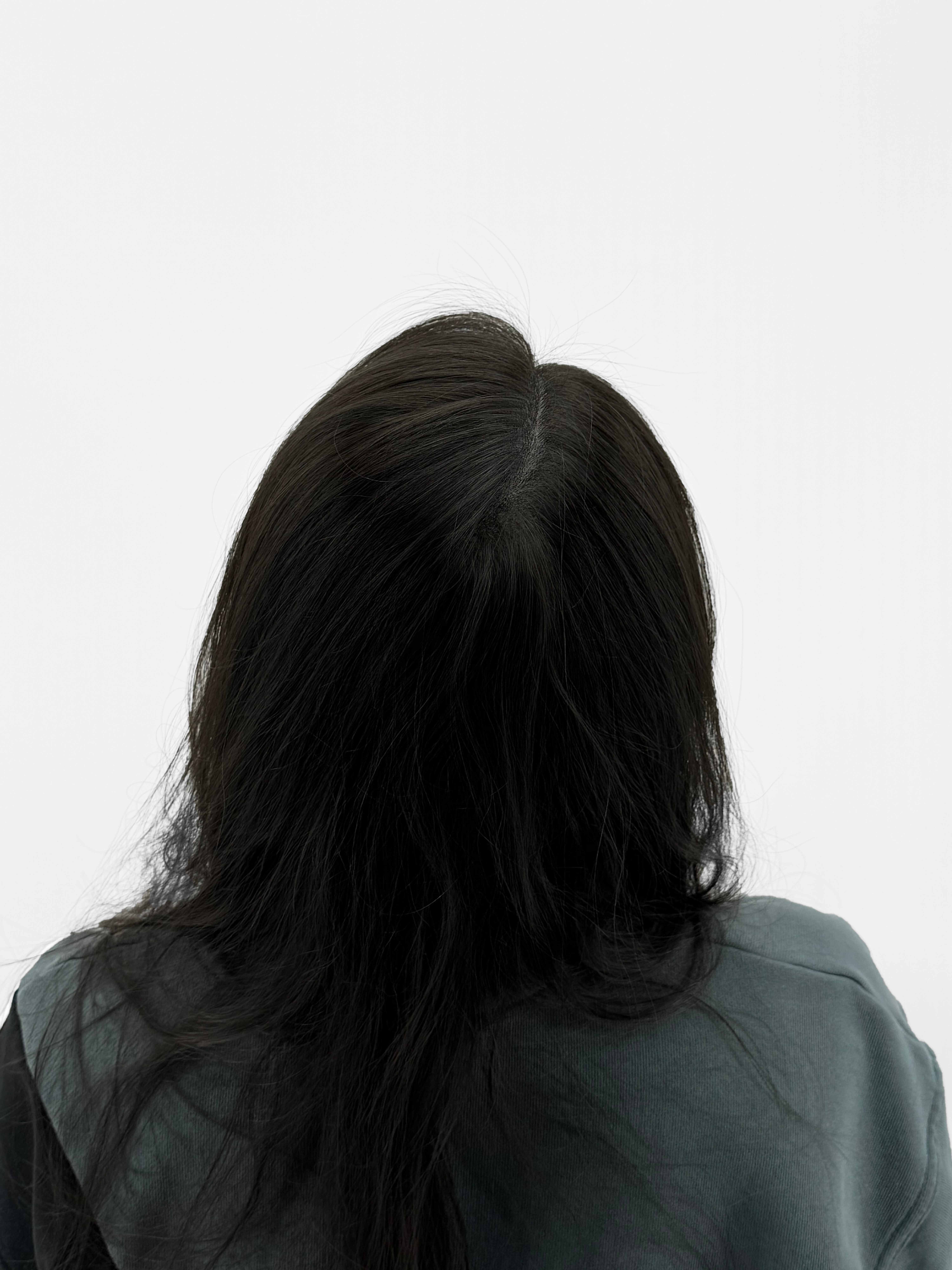 여성 정수리 시술 - 시술 후