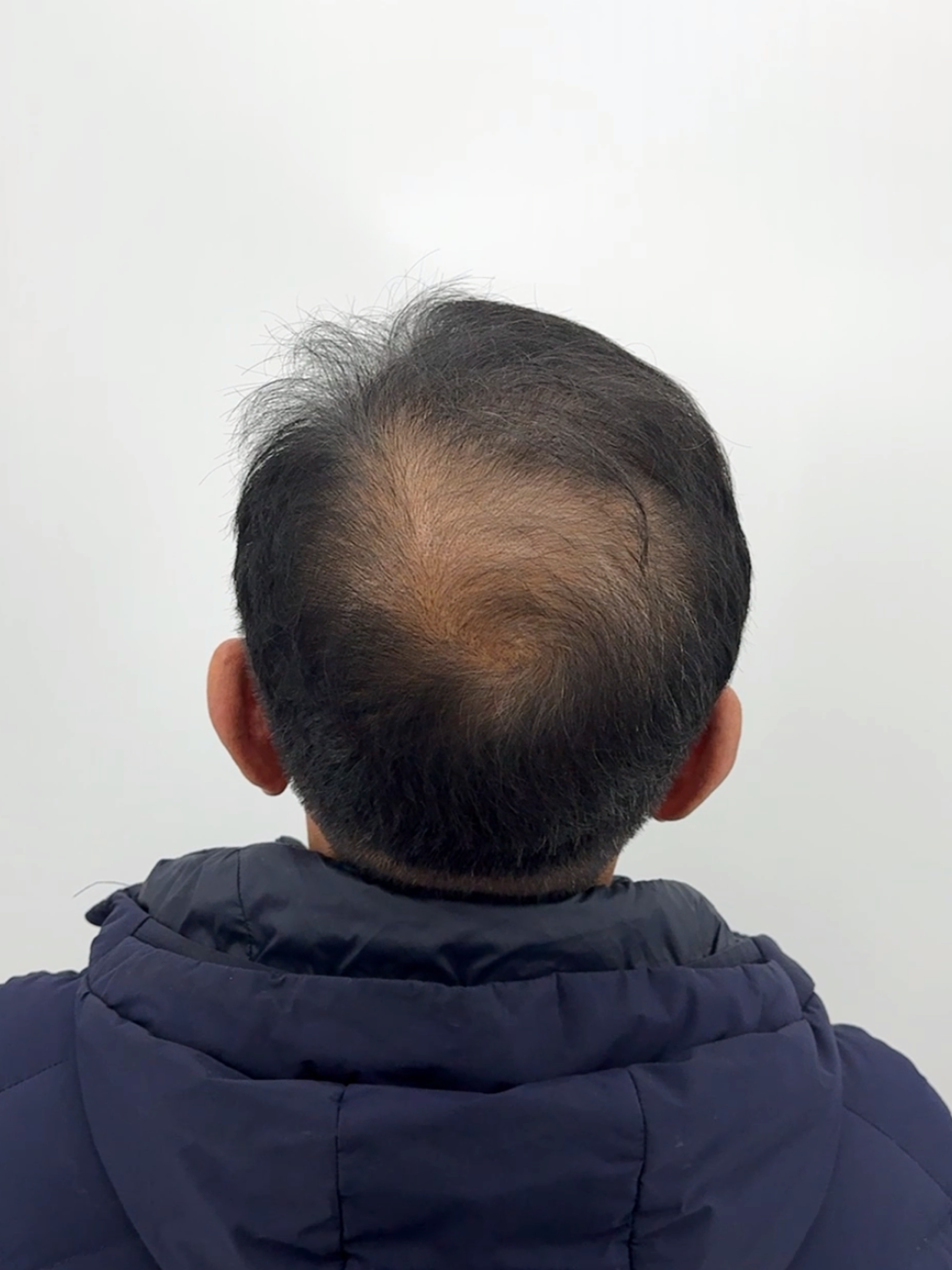 정수리 탈모 시술 - 시술 전