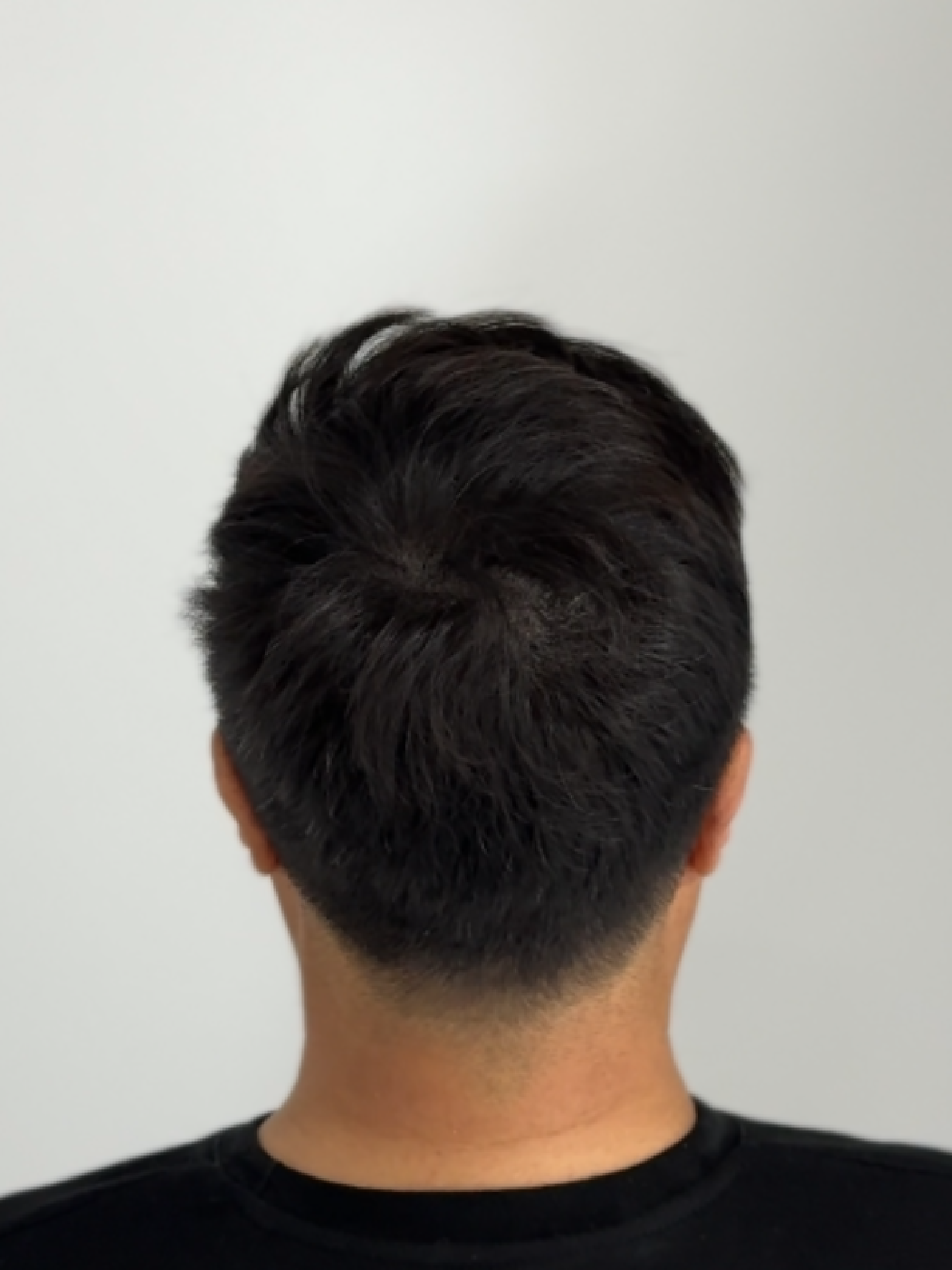 정수리 밀도 개선 - 시술 후