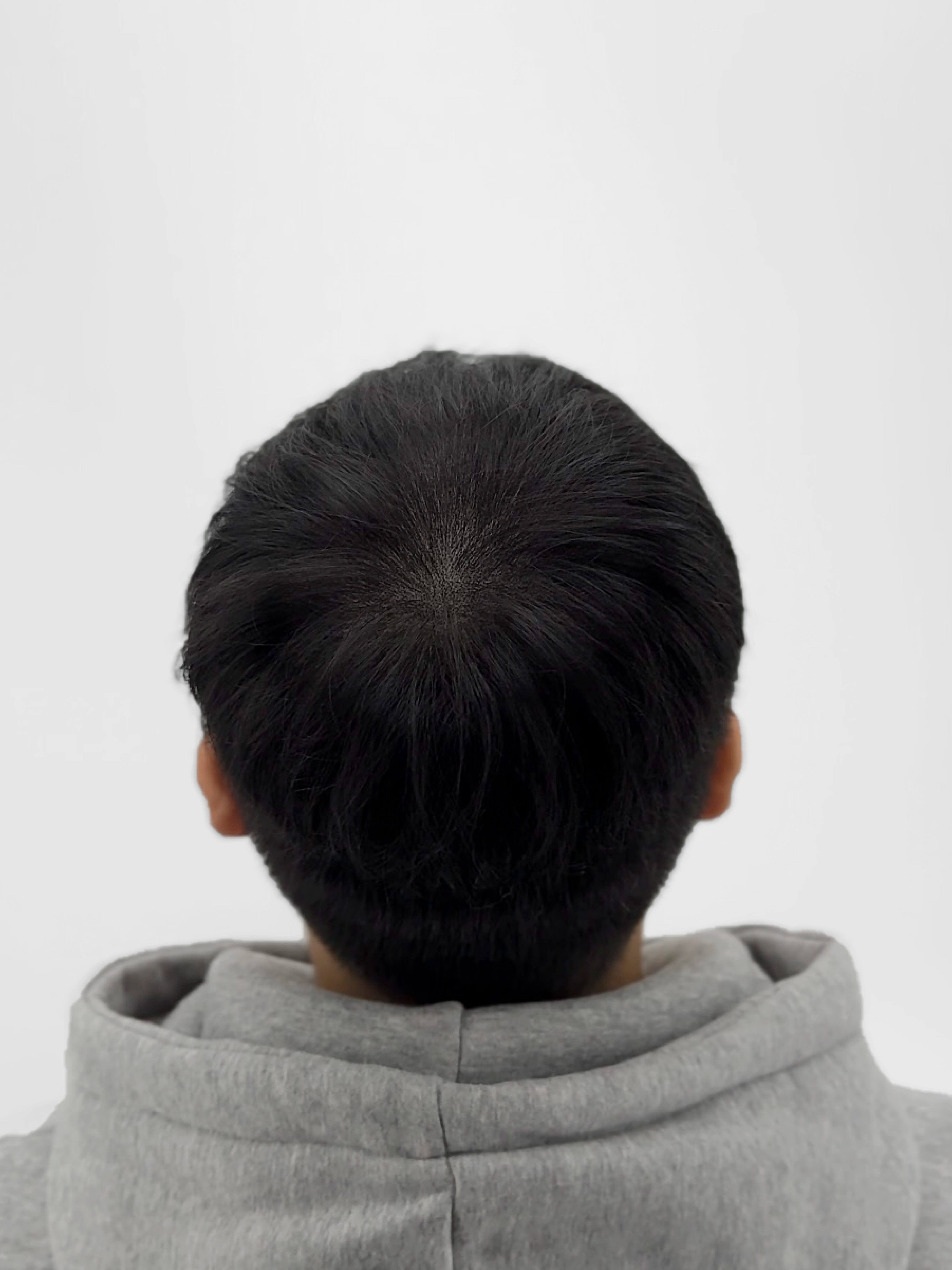 정수리 SMP 시술 - 시술 후