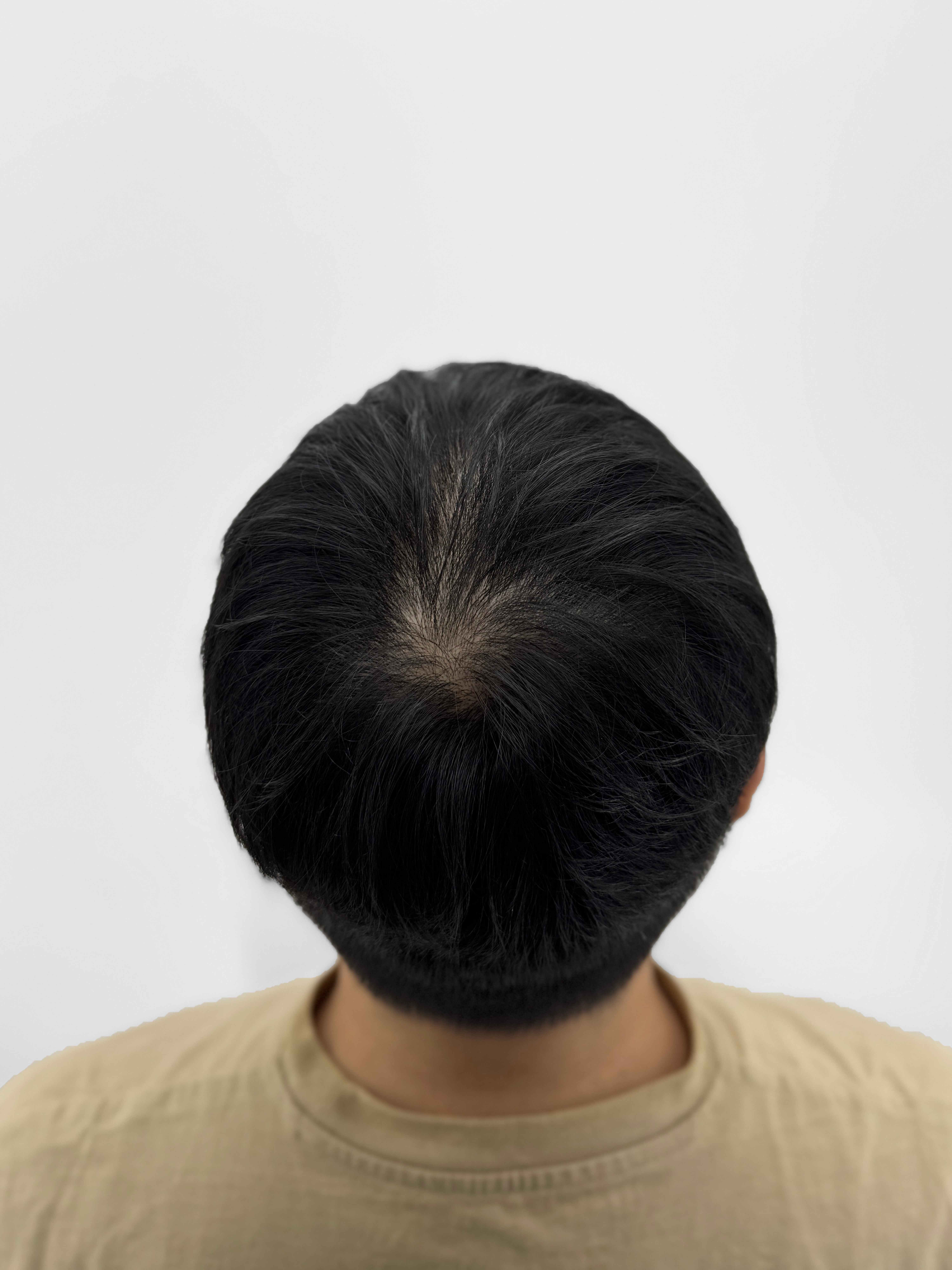 정수리 SMP 시술 - 시술 전