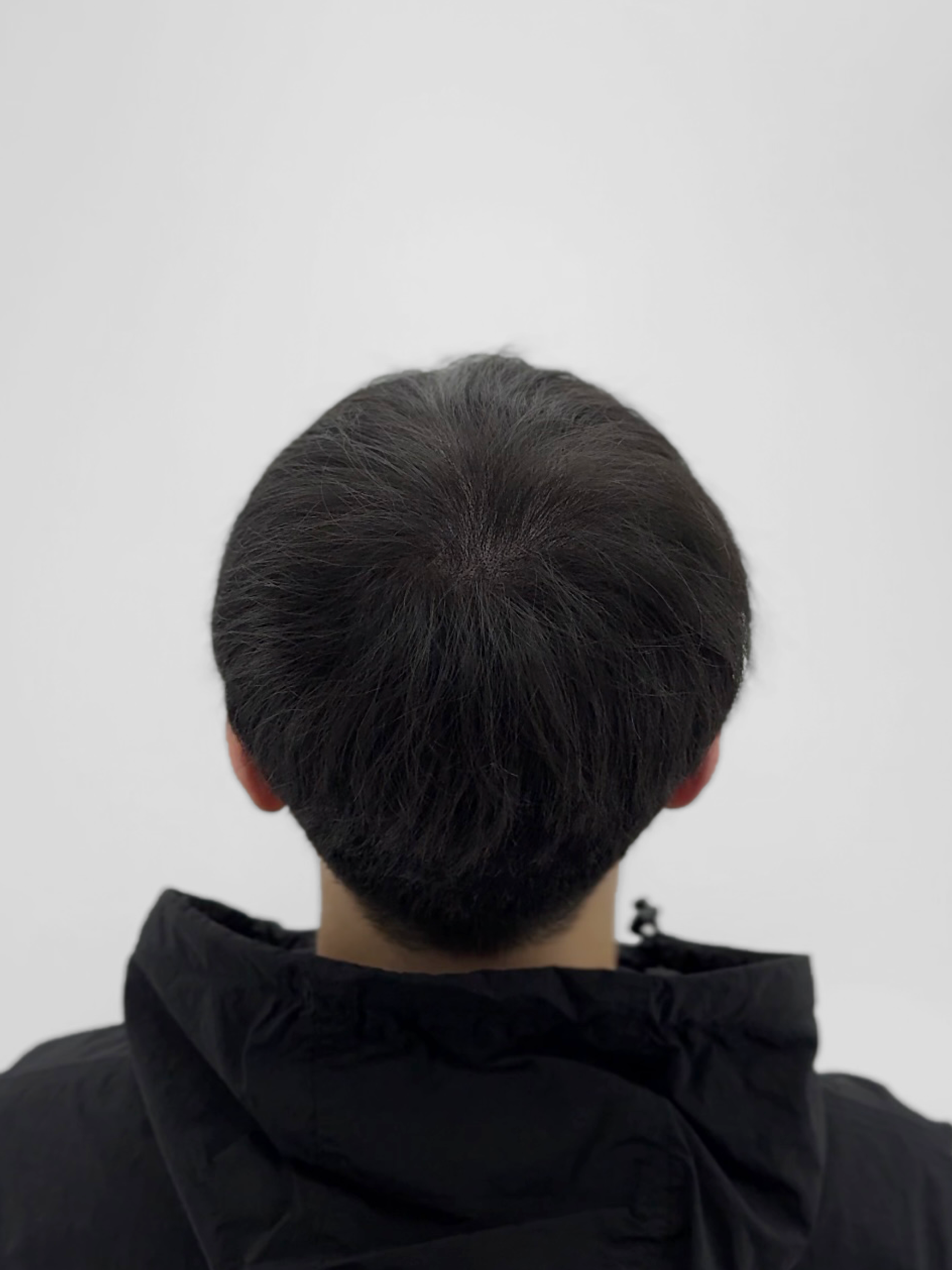 정수리 탈모 개선 - 시술 후