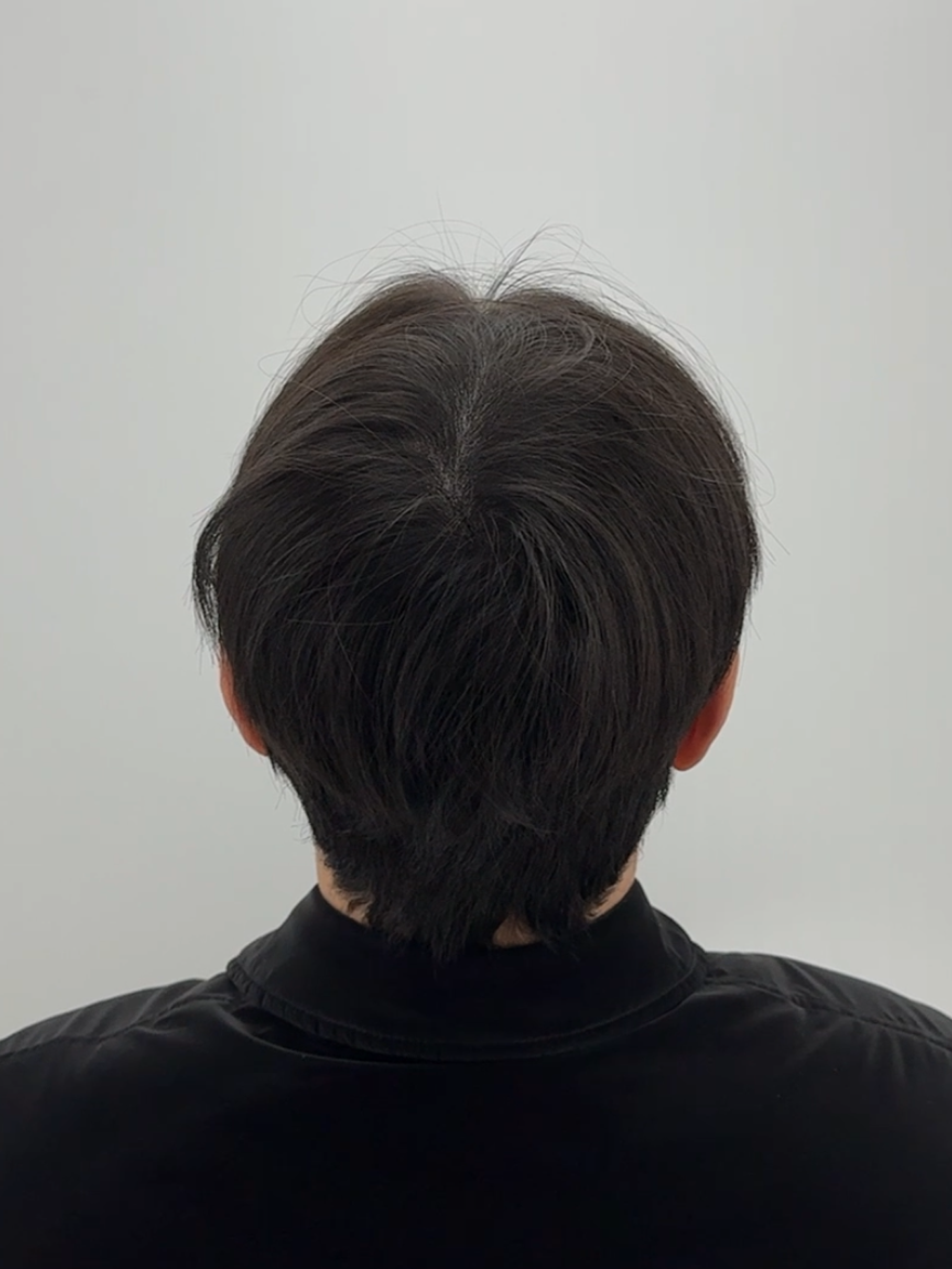 정수리 밀도 복원 - 시술 후