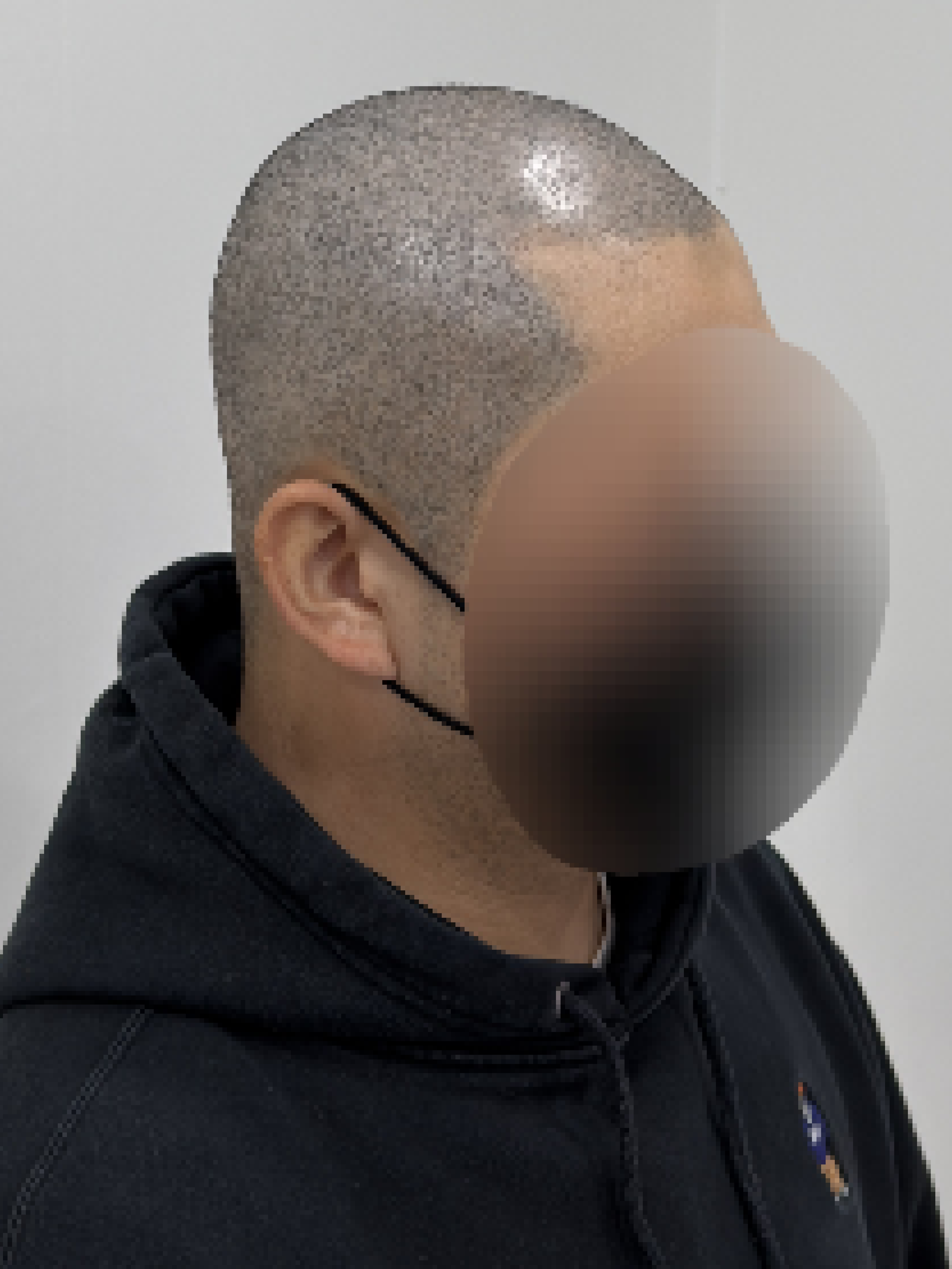 삭발 SMP 시술 - 시술 후