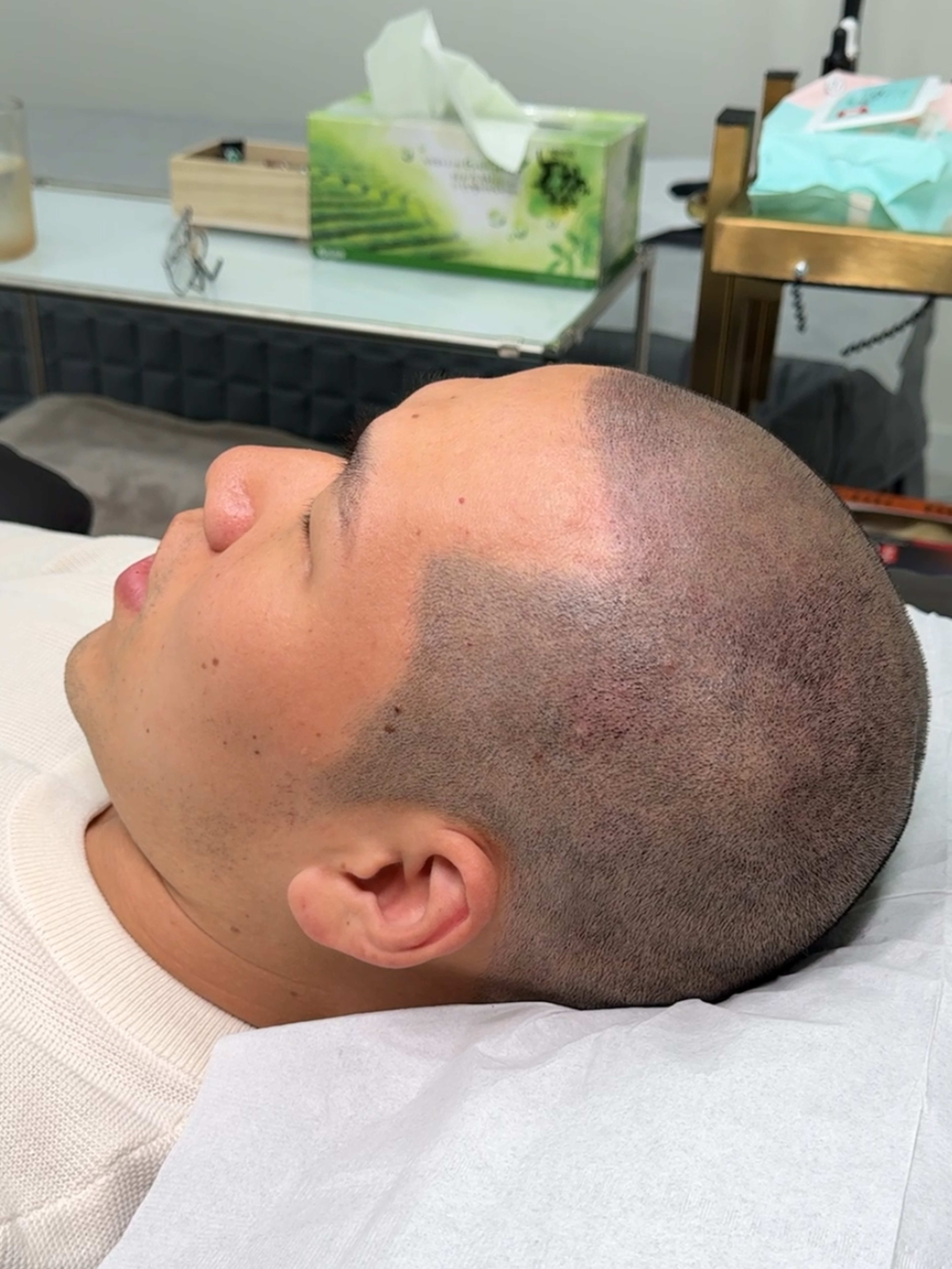 삭발 SMP 시술 - 시술 후