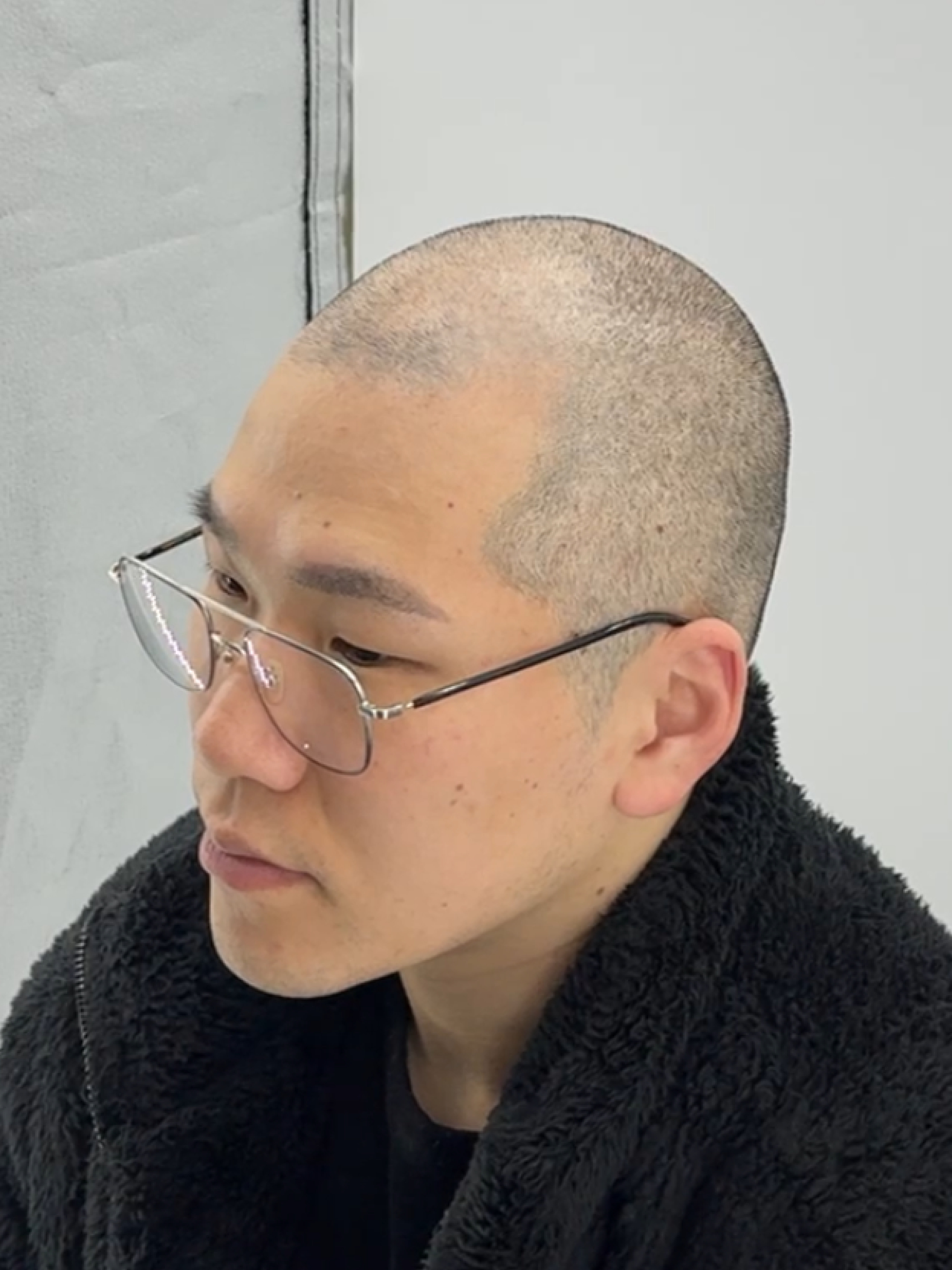 삭발 SMP 시술 전